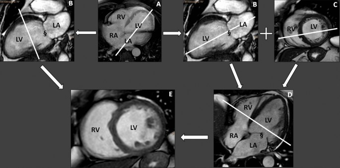 Cardiac MRI