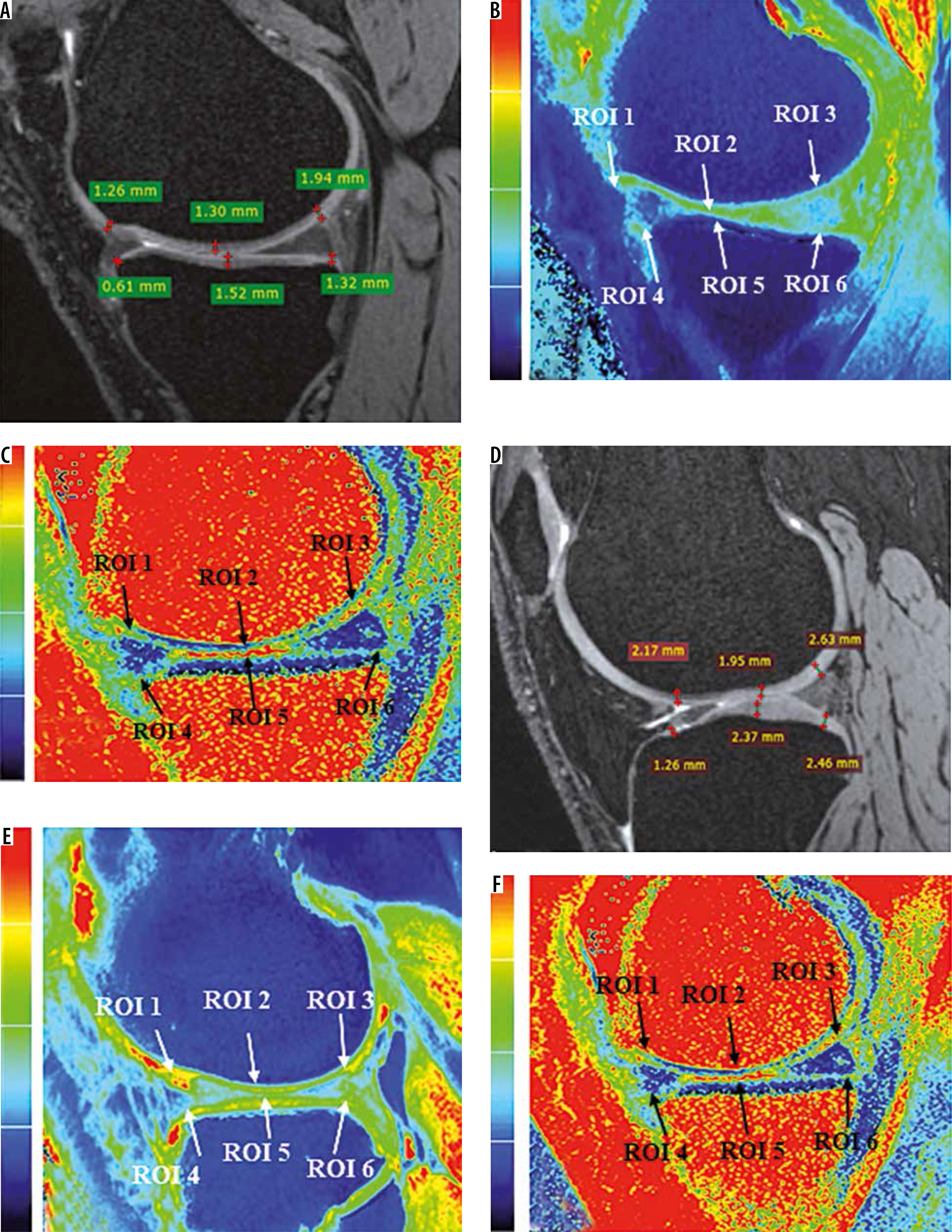 Cartilage Mapping