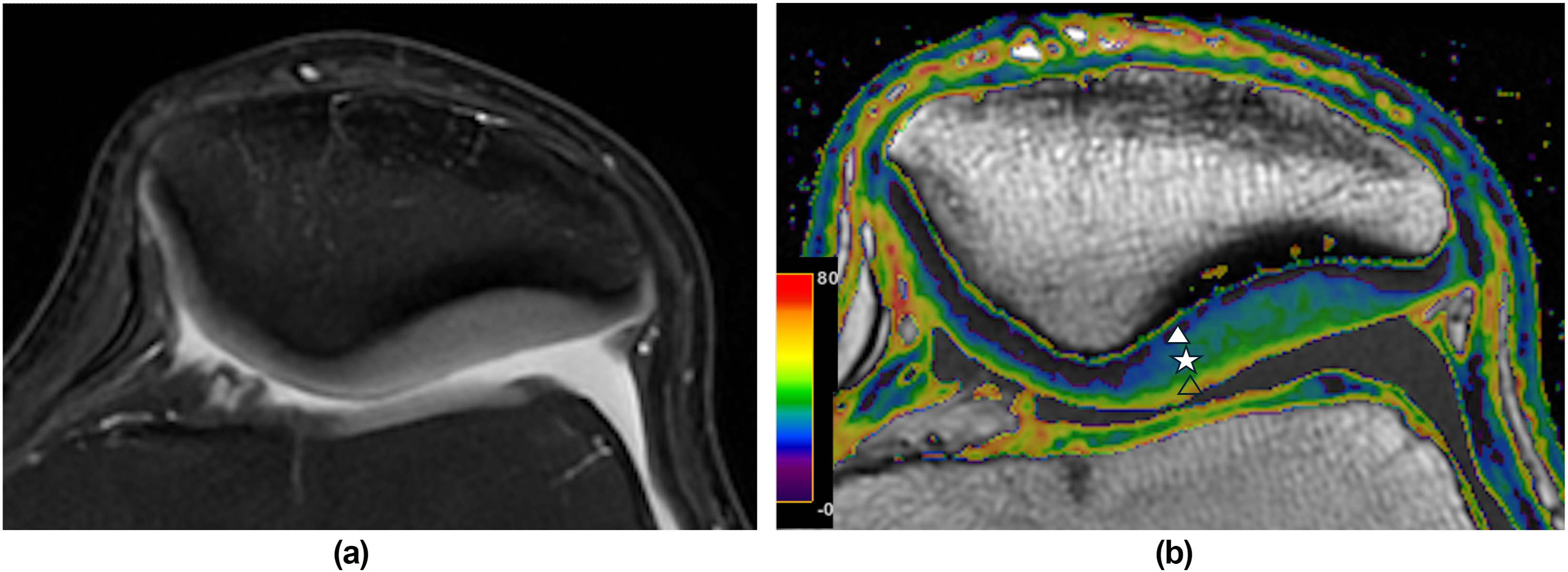 MRI Cartilage T2 Mapping