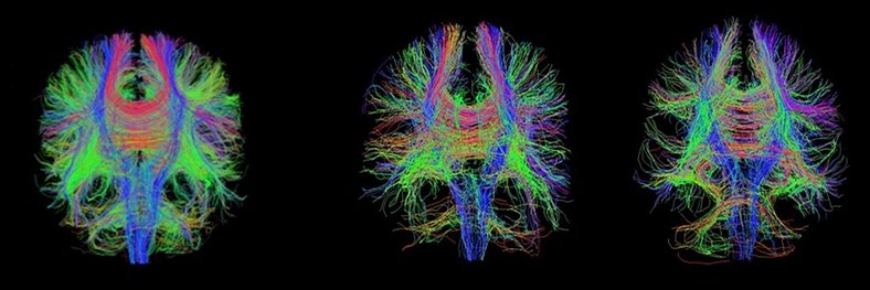 DTI Multiview Tractography